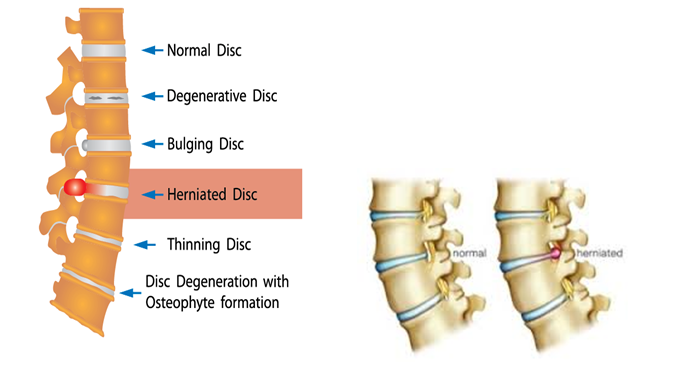 Are You At Risk Of Herniated/Slipped/Ruptured Disc?