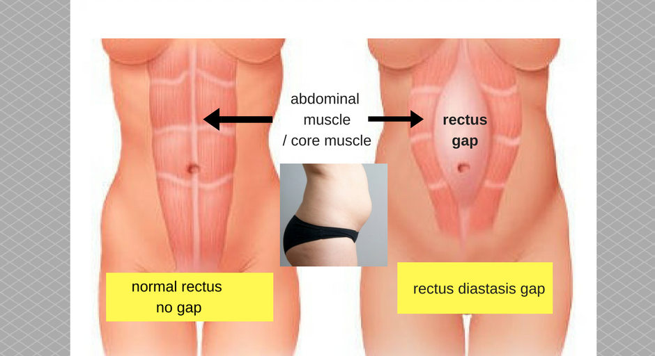What is a Tummy Gap?