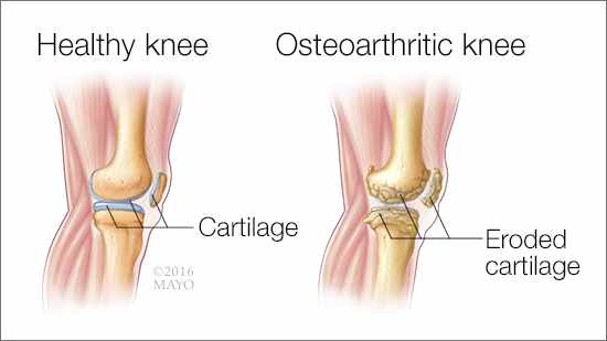 Osteoarthritis (OA)