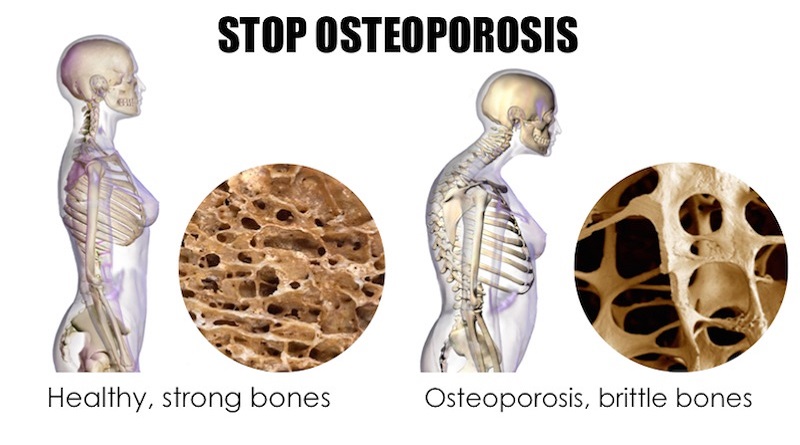 World Osteoporosis Day- ‘Love Your Bones’