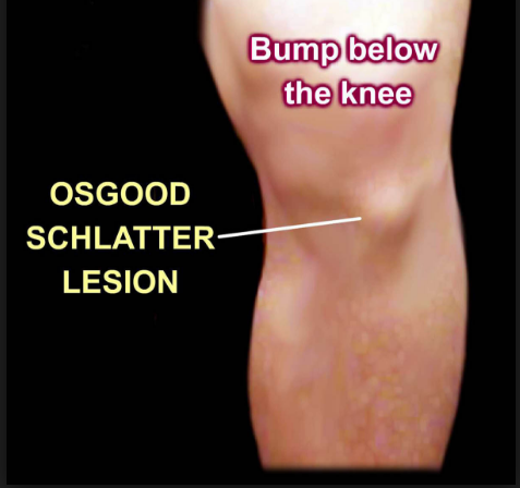 Help! My Child Is Complaining Of Knee Pain