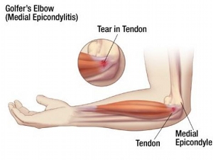golfers elbow