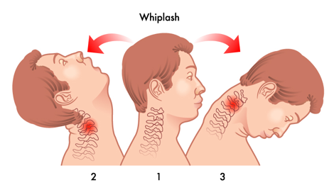 Neck Pain Or Whiplash? Know The Difference