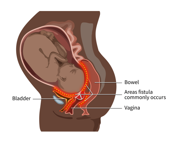 Have You Heard About Fistula?