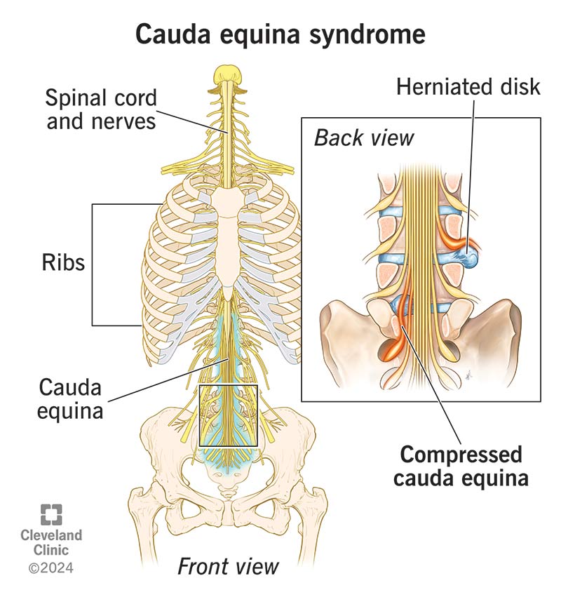Cauda Equina Syndrome: Causes, Symptoms, and Urgent Treatment Options