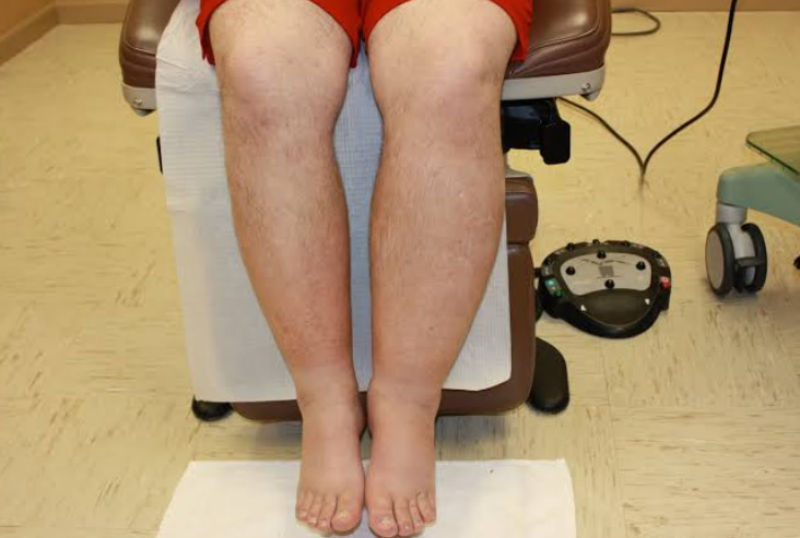 Lymphedema Swelling