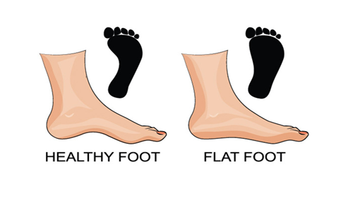 Flat Feet