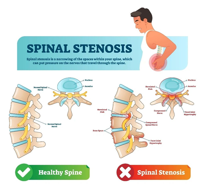 Lumbar Stenosis Pain and Exercises to Help