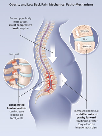 Obesity and Low Back Pain