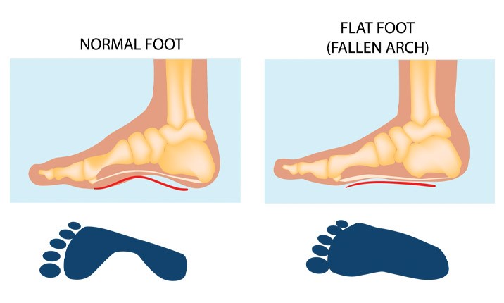Flat Feet and Back Pain: Understanding The Connection And Finding Relief