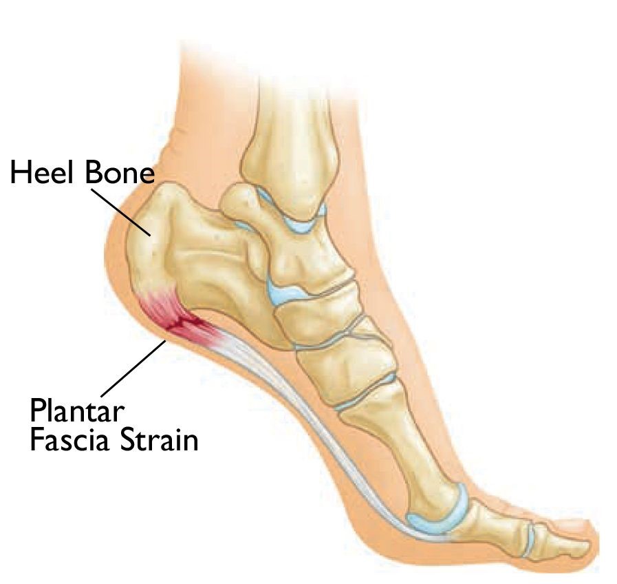 How Plantar Fasciitis Affects Movement And Function.