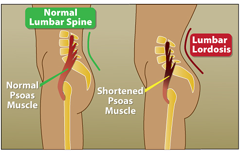 The ‘Psoas Syndrome’