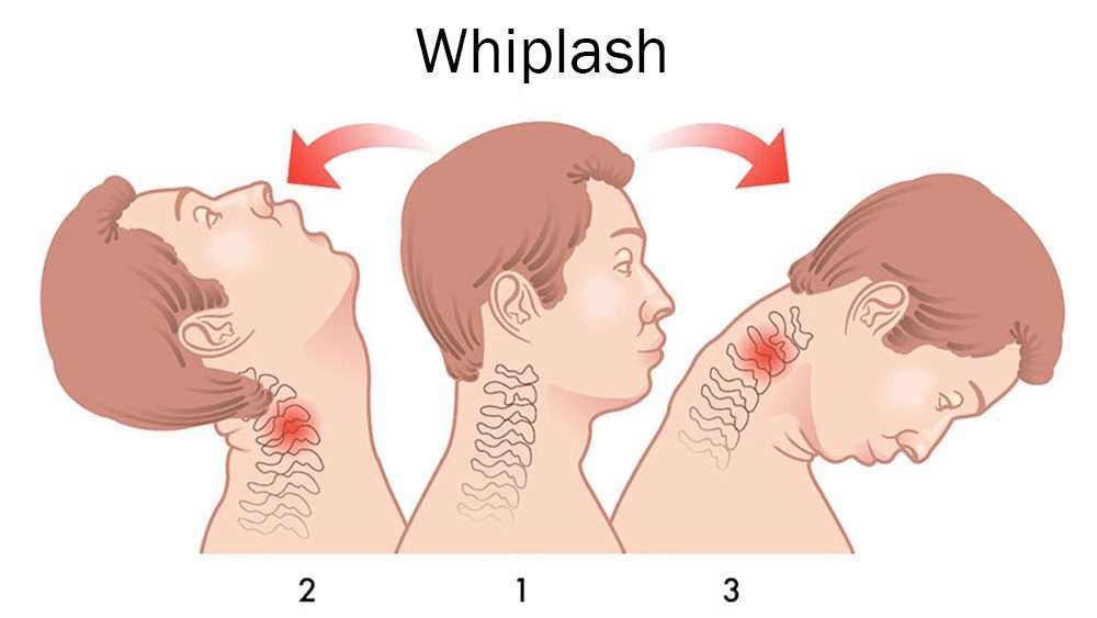 Understanding Whiplash: Causes, Symptoms, and Treatment Options