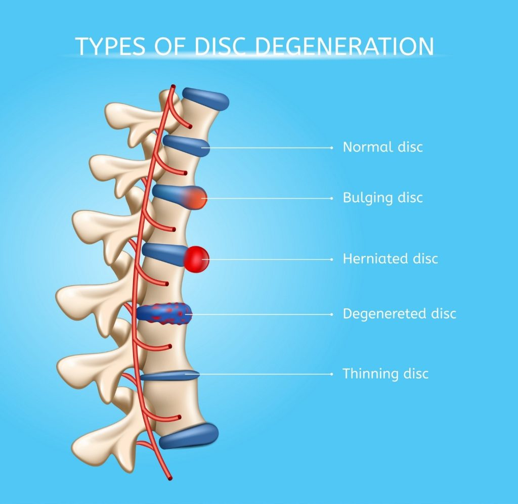 Managing Degenerative Disc Disease: What to Avoid and How to Slow Its Progression