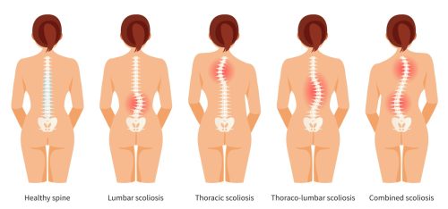 Understanding Scoliosis: Types, Treatments, and When to Seek Help